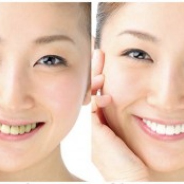 Tooth whitening